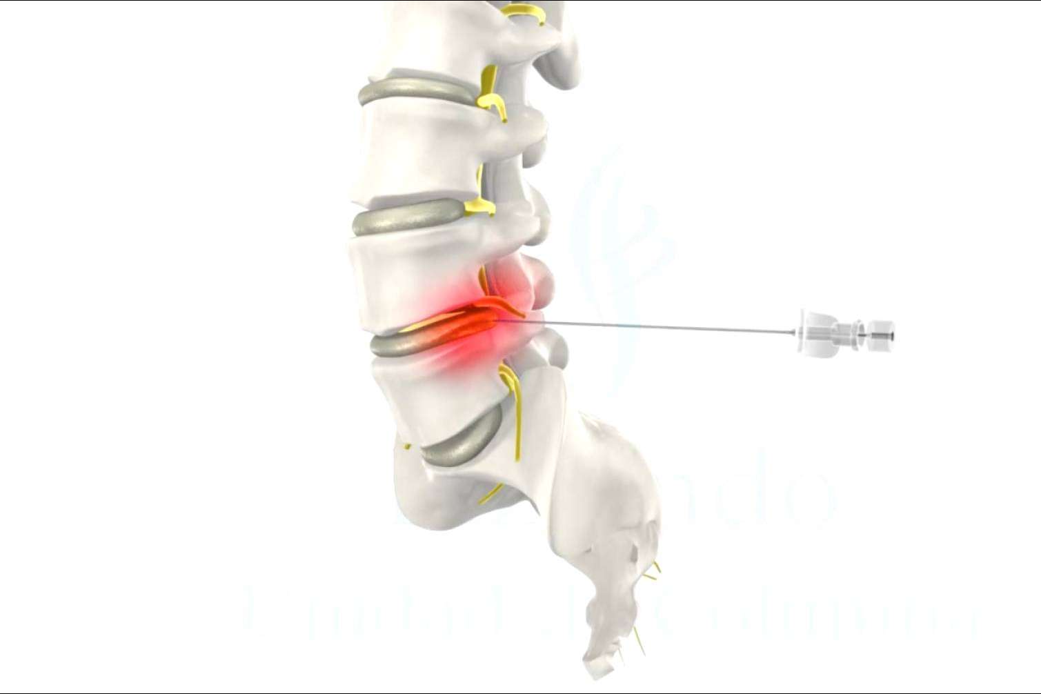 La innovadora cirugía de hernia discal se realiza en menos de una hora y no requiere ingreso hospitalario