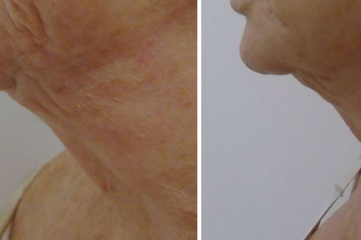 Especialistas en rejuvenecimiento del cuello; Dr. Tufet Madrid y Renophase