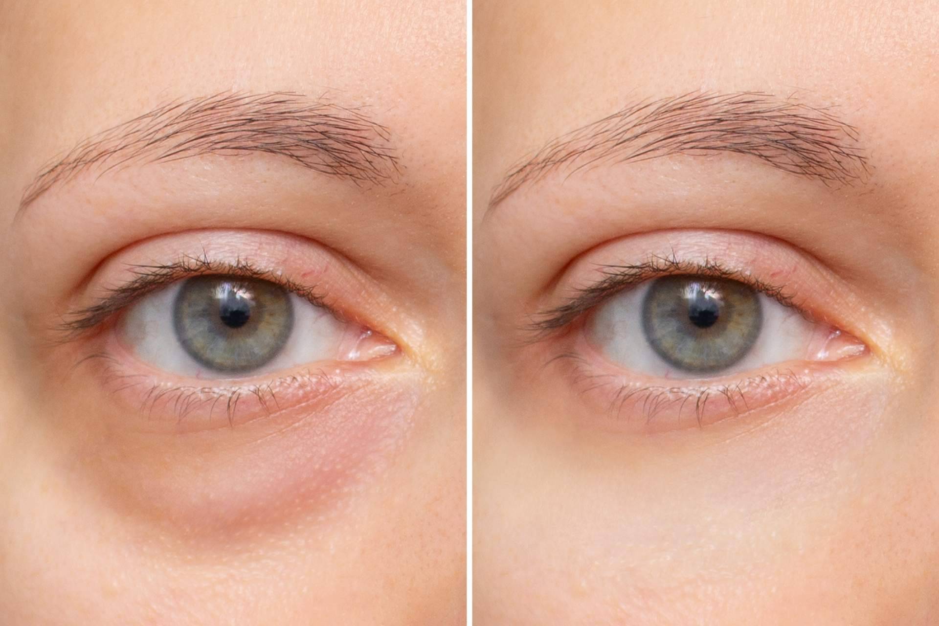 Oculoplastia de última generación, de la mano del Departamento de Oftalmología del Hospital Universitario Dexeus