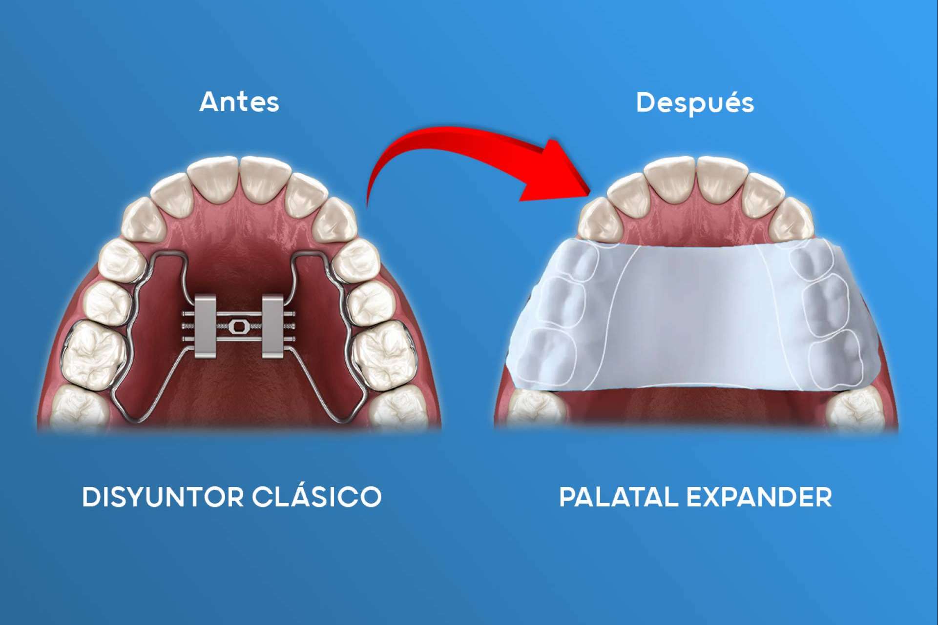 Doctores murcianos lideran la revolución en ortodoncia con expansores plásticos innovadores
