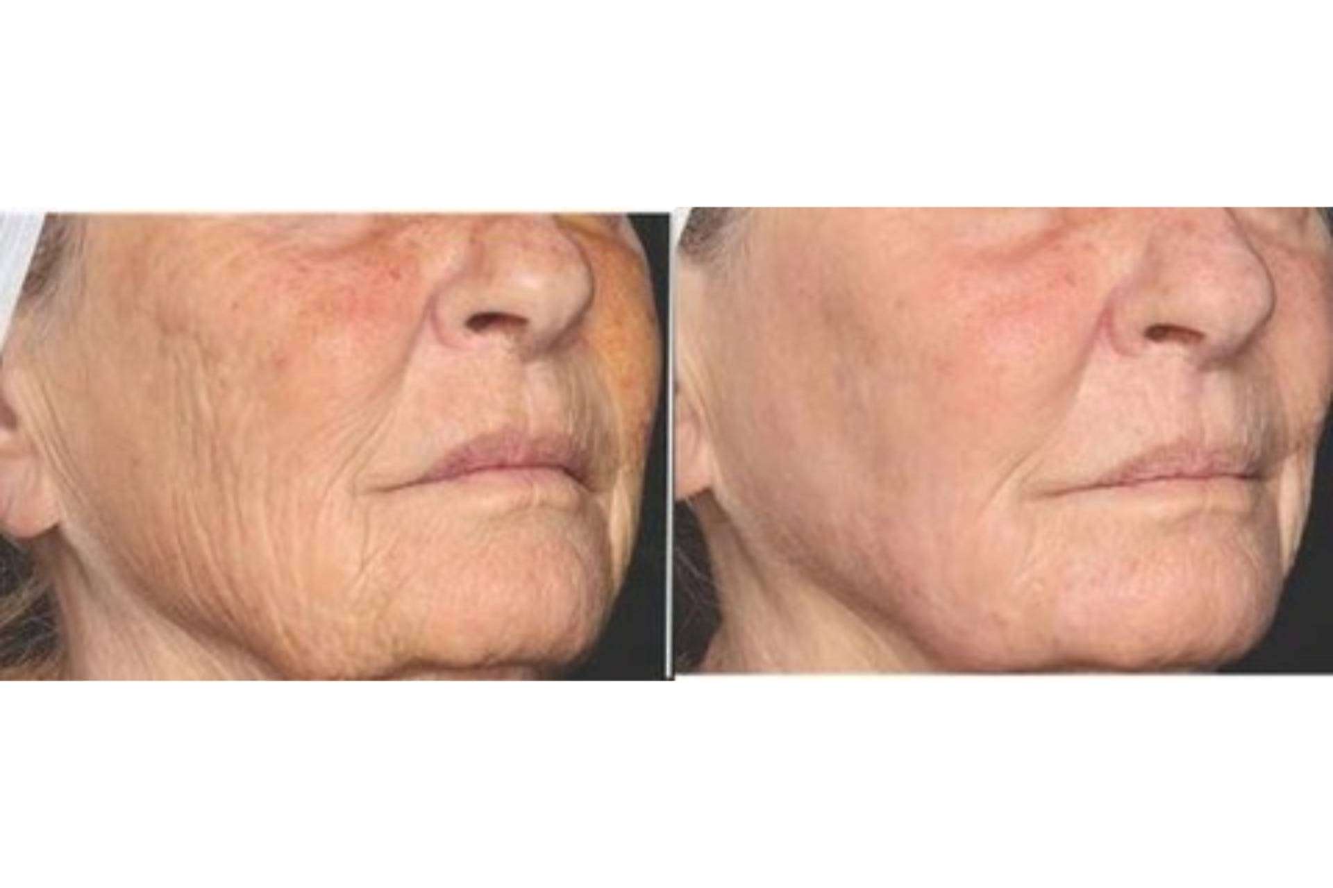 Clínica Dermatológica Internacional incorpora el láser frío regenerativo que combate los signos de la edad