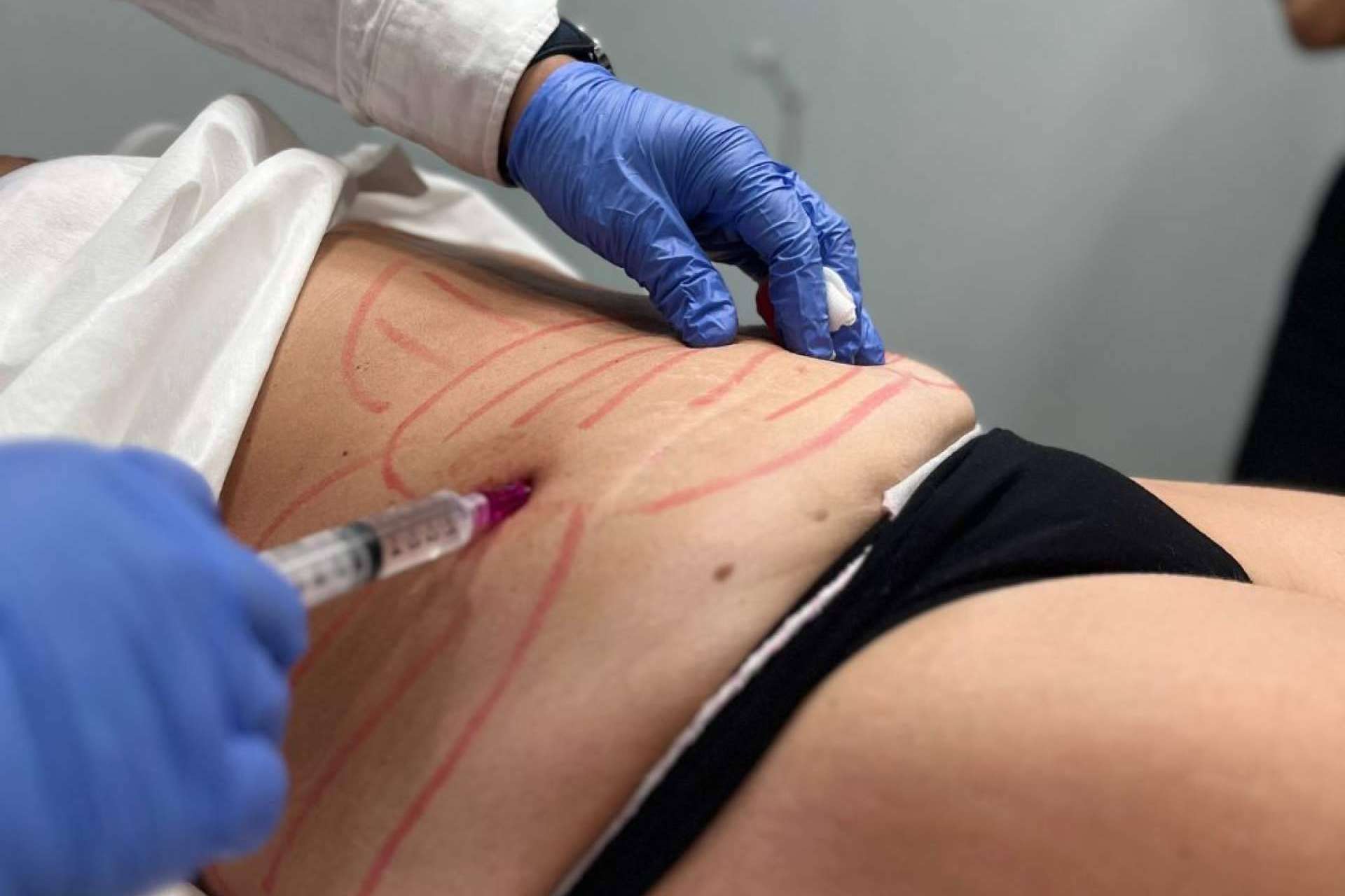 360Clinics impulsa el tratamiento Lipoláser Fit como alternativa no quirúrgica para redefinir la silueta corporal