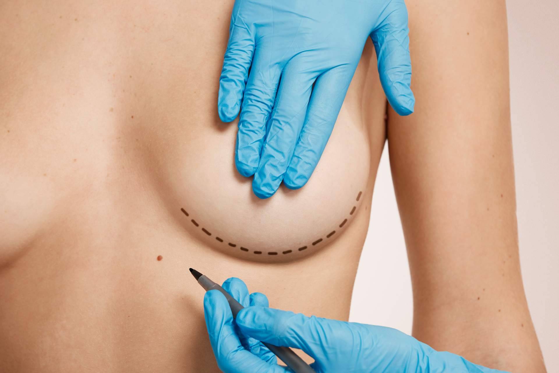 Estética mamaria; intervenciones adaptadas al cuerpo y objetivos de cada paciente